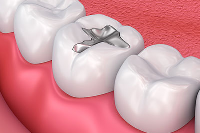 The image depicts a close-up view of a set of teeth with a silver ring in between them.