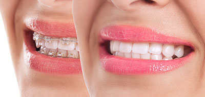 The image shows a close-up of two smiling women with teeth showing, wearing lipstick.