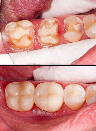 The image shows a close-up view of an open mouth with teeth that appear damaged and yellowed, likely due to dental issues such as decay or staining. There are two photos  one showing the teeth in their natural state and another depicting the same teeth after cleaning or treatment, demonstrating an improvement in oral hygiene.