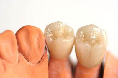 The image displays a close-up view of two teeth with visible dental work, set against a white background.