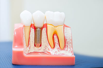 A close-up view of a dental implant model with multiple teeth, showing the screws and abutments used for implants.