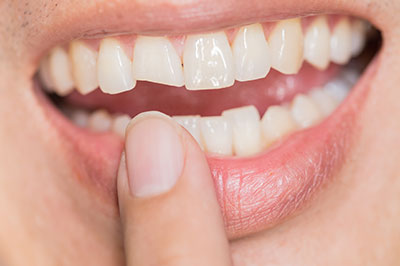 The image shows a close-up view of an individual s mouth with teeth, holding a finger under their lower lip, displaying a smile, with a focus on dental health.