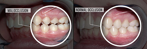 The image shows a person s teeth with a focus on a tooth extraction process, with two different views of the same mouth, one showing an intact row of teeth before extraction and the other showing only the lower front teeth after extraction, highlighting the removal of multiple teeth.