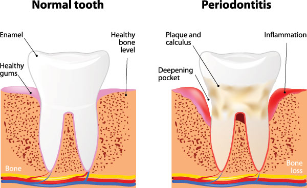 The image displays two illustrations labeled  Normal tooth  and  Periodontitis,  showing differences between healthy teeth and teeth affected by periodontal disease, with annotations indicating a healthy tooth on the left and a diseased one on the right.