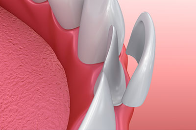 The image shows a close-up view of a dental implant with an artificial tooth attached, set against a pink background that could represent gum tissue.