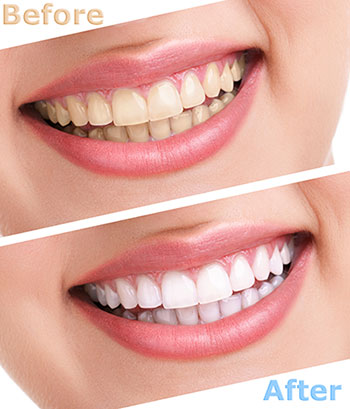 The image shows a before-and-after comparison of teeth whitening treatment, with the top photo showing yellowed teeth and the bottom two photos displaying brightly white teeth.
