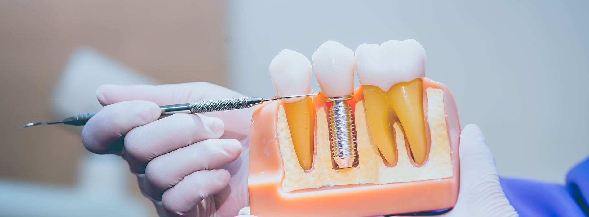 The image shows a close-up view of a dental procedure being performed, with a person s hand holding a drill over an open mouth of a patient whose teeth are visible, and there is a focus on a tooth that appears to be receiving dental treatment.