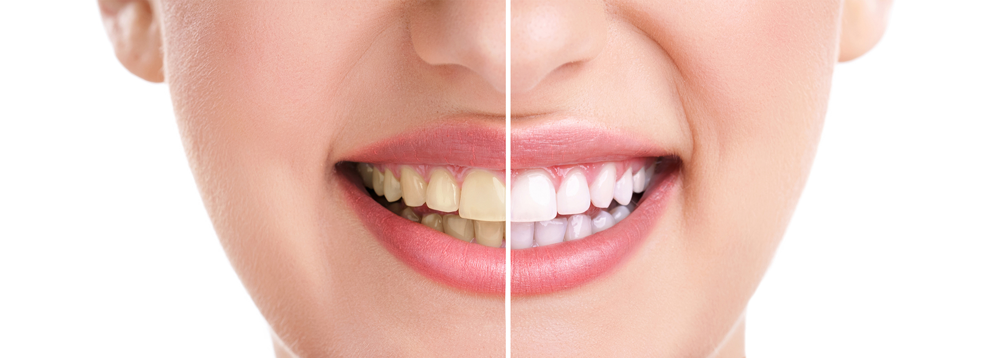 The image shows a close-up of a person s face with a focus on their teeth, which are being highlighted by a white border around them.