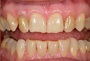 The image shows two close-up photographs of teeth with yellowing, likely due to staining or poor oral hygiene.
